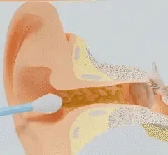 Smart medical cutting-edge technology - visual ear canal cleaning
